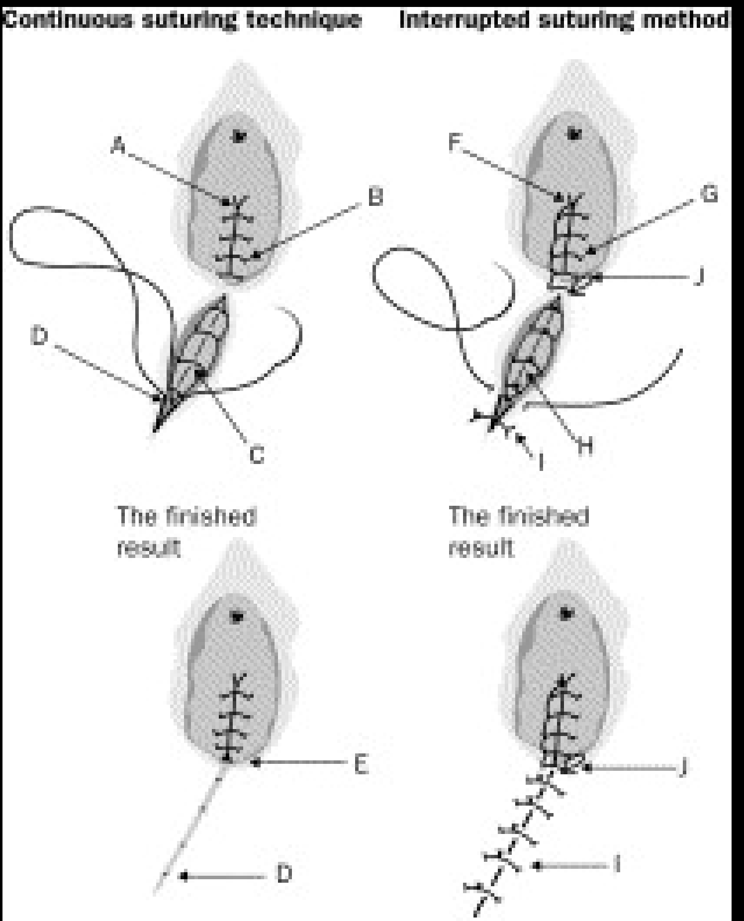 Demonstration of two suturing methods for episiotomies